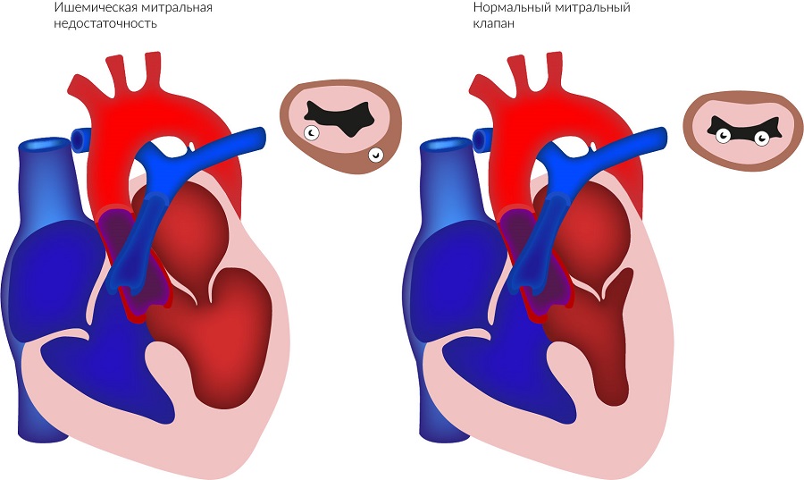 mitralnaya_nedostatochnost.jpg
